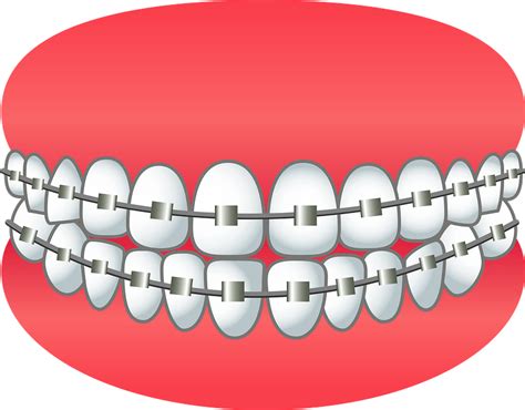 Free Braces Clipart Download Free Braces Clipart Png Images Free