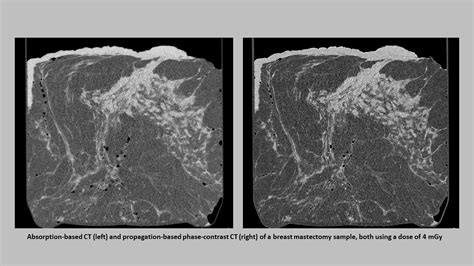 Phase Contrast Imaging For Breast Cancer Diagnosis Syntec Optics
