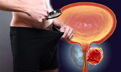 Prostate Cancer Symptoms If You See This In Your Semen Do Not Ignore