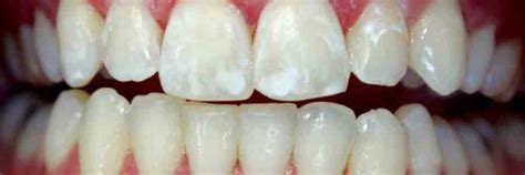 Prevent White Spots On Teeth While Wearing Braces Vancouver