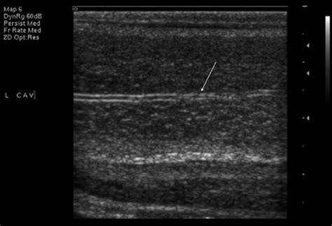 Longitudinal Ultrasound Image Of Left Cavernosal Artery Arrow Within