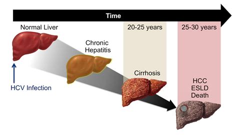 Hepatitis c is an infectious disease caused by the hepatitis c virus (hcv) that primarily affects the liver; Core Concepts - Natural History of Hepatitis C Infection ...