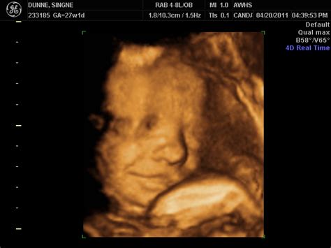 5d ultrasounds claim to be the gold standard of ultrasound technology, but are they any different to 3d ultrasounds? The Dunne Family: 3D Ultrasound Pictures 28 weeks