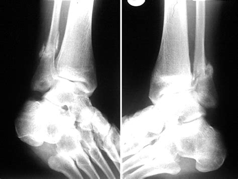 Bilateral Distal Fibular And Tibial Stress Fractures Associated With