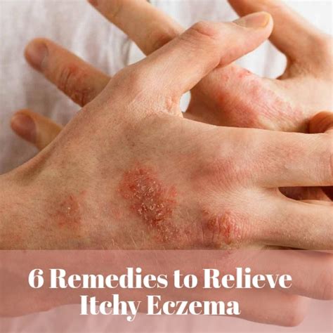 Allergic Contact Dermatitis Types Causes And Treatments