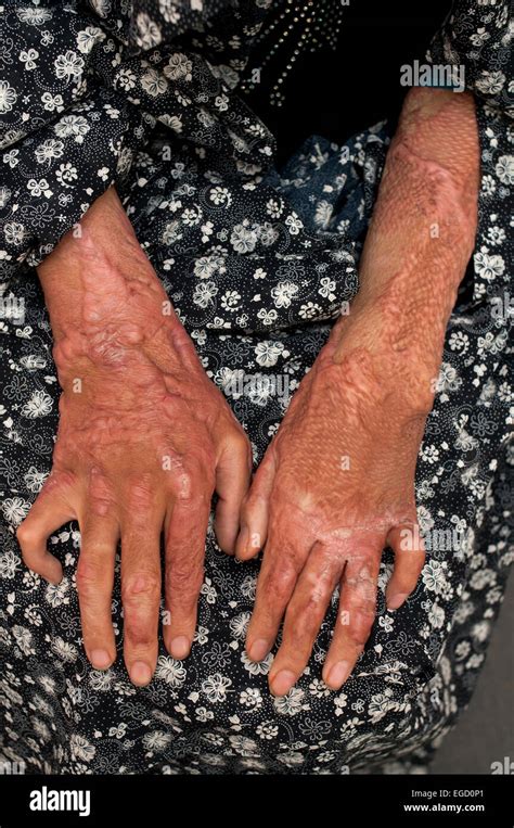 Severely Burnt Hands Of A Woman Who Was Held Down By Her Mother In Law And Forced To Set Herself