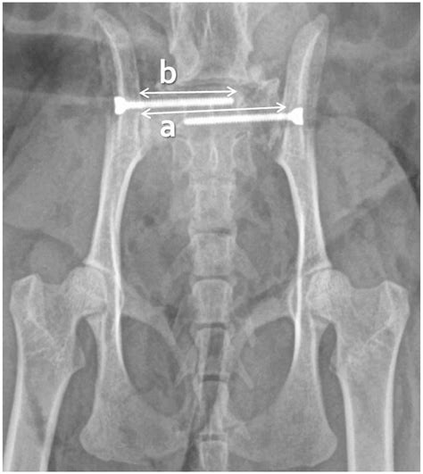Evaluation Of A Screw Insertion Landmark For A Minimally Invasive