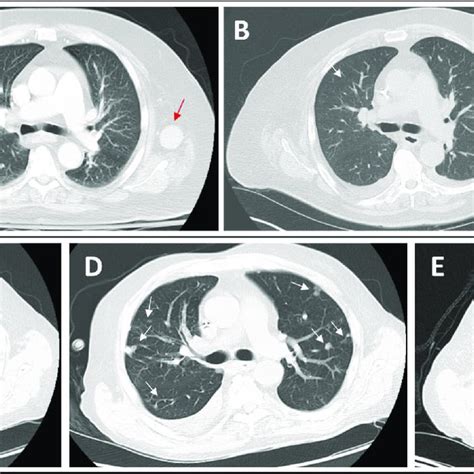 Radiographic Improvement In Disease A Case 1 Baseline Chest Ct In
