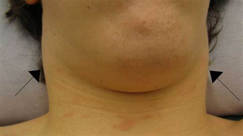 Rash And Swollen Lymph Nodes Causes Photos And Treatment In 2020