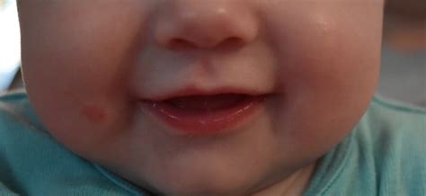 Babys Lips Red With Blisters And Ringworm Pic Included Babycenter