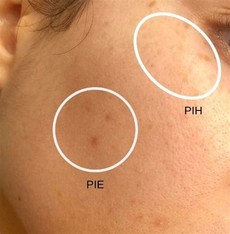 Acne Scarring Pih And Pie Differences Causes And Treatments — Babe