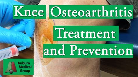 Knee Osteoarthritis Treatment And Prevention Auburn Medical Group