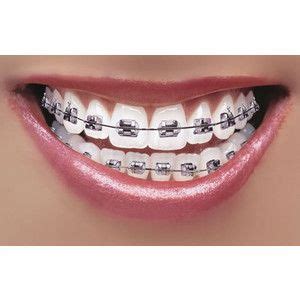 What are some effective ways to whiten teeth with braces still attached? The 25+ best Braces colors ideas on Pinterest | Getting ...