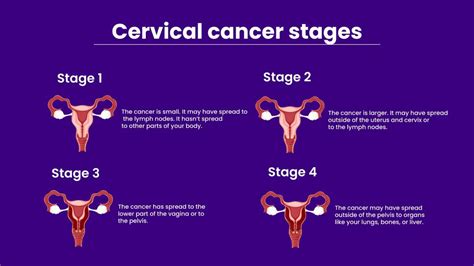 Different Stages Of Cervical Cancer