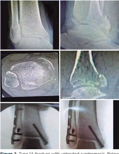 Figure From Posterior Malleolar Fractures New Classification And Treatment Algorithm