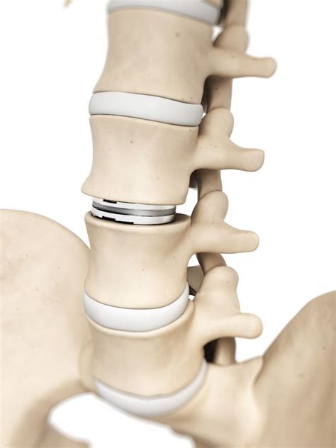 Lumbar Low Back Implants Stabilize The Spine Sciatic Nerve Pain