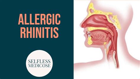 Allergic Rhinitis Complete Explanation Part 1 Youtube