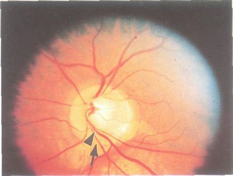 The Optic Nerve In Glaucoma Intechopen