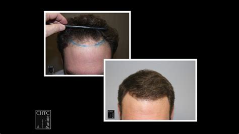 Panine Md Chicago Hair Transplant Clinic Hair Restoration Patient