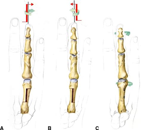 Modified Step Cut Osteotomy For Metacarpal And Phalangeal Rotational
