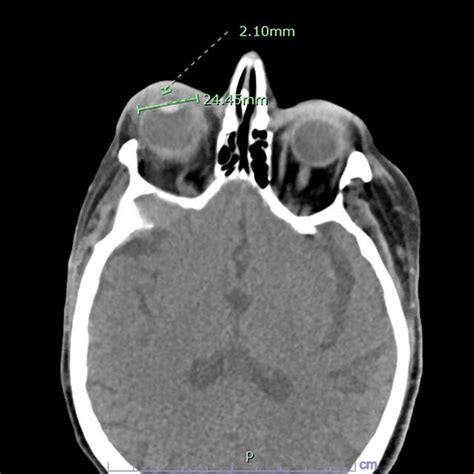 Ct Of The Orbits Shows Stranding Of Retrobulbar Intraconal Fat And