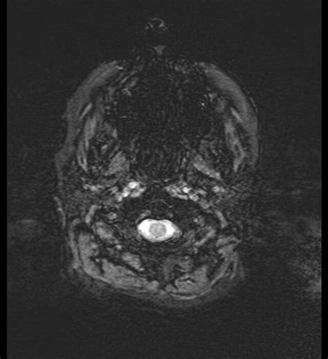 Choroid Plexus Xanthogranuloma Radiopaedia 91271 108875 Axial Swi