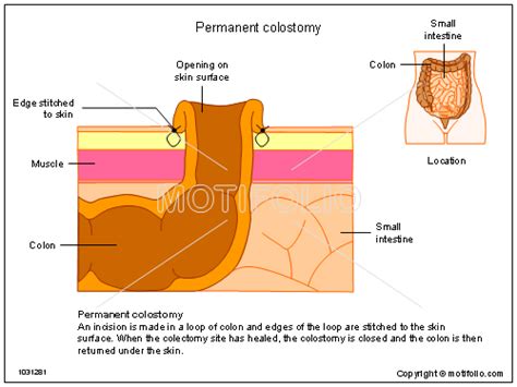 Permanent Colostomy Illustrations