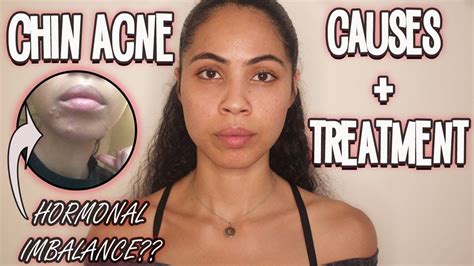 Chin Acne Why Youre Getting It And How To Prevent It Naturally Youtube