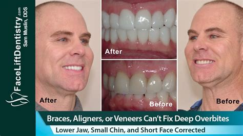 Braces Aligners Or Veneers Cant Fix A Deep Overbites Short Face