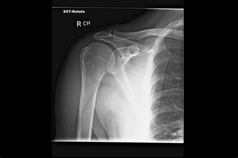 Ortho Dx Shoulder Pain Without Arthritis Clinical Advisor
