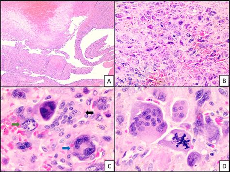 Cureus Undifferentiated Pancreatic Carcinoma With Osteoclast Like