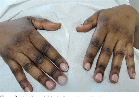 Pdf Acanthosis Nigricans A Common Significant Disorder Usually
