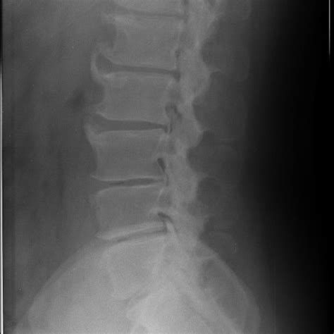 Representative Radiograph Of Anterior Lumbar Vertebral Osteophytes 72