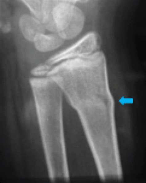 Buckle Fractures Torus Fractures Campbell Clinic Orthopaedics