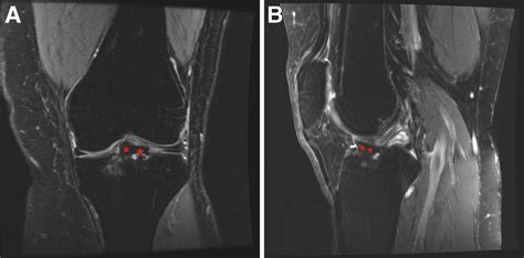 Preoperative Magnetic Resonance Imaging Scans Of The Left Knee With