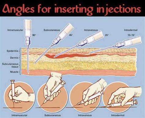 Intradermal Injection