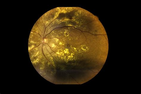 View Inside Human Eye Disorders Showing Retina Optic Nerve And Macula