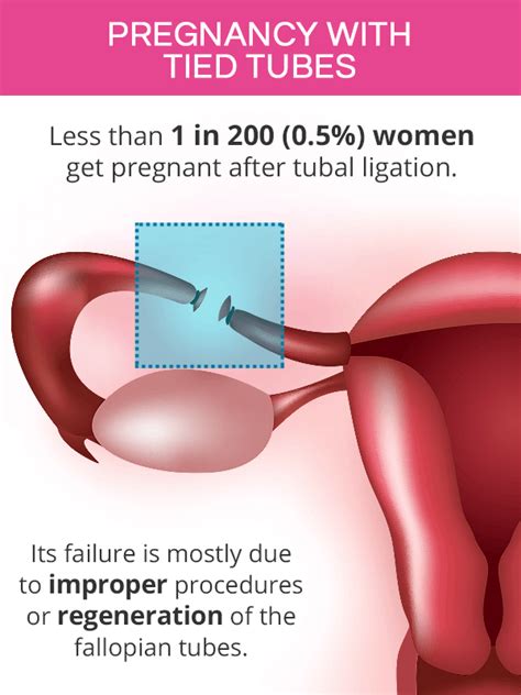 Chances Of Getting Pregnant After Tubal Ligation Shecares