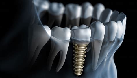5 Things You Should Know About Dental Implants Huffpost
