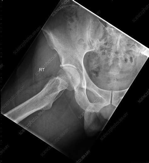 Normal Hip X Ray Stock Image C0393298 Science Photo Library