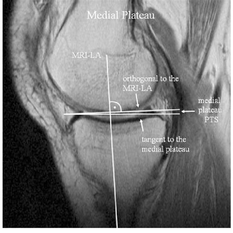 Pdf Novel Measurement Technique Of The Tibial Slope On Conventional Mri