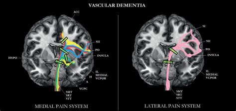 Read the latest medical research on dementia. Pain in People with Dementia—Its Relationship to ...