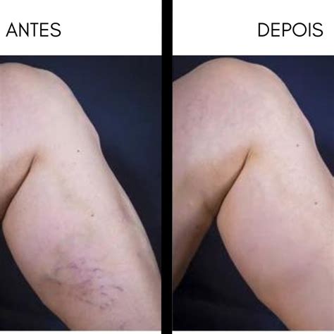 Peim Microvasos Antes E Depois