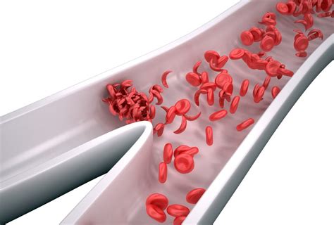 Sickle Cell Disease Non Communicable Disease And Injury Prevention And
