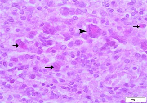 Light Micrograph Of Lung Tissue Showing Granulomatous Reaction