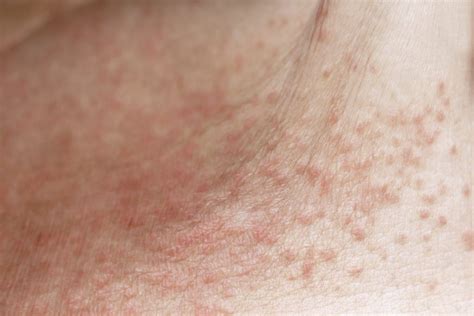 Dermatite Da Sudore Cause Sintomi E Cure Ohga