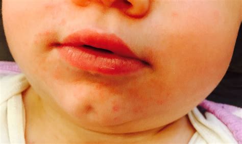 That Red Rash Around Your Childs Mouth Lip Licking Dermatitis