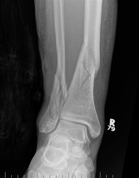 Distal Tibial Fractures The Bone School