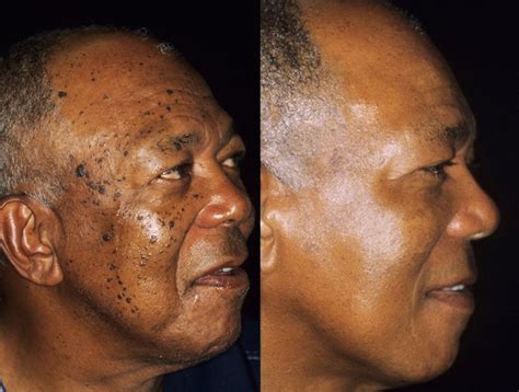 Dermatosis Papulosa Nigra Removal Before And After