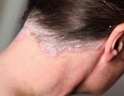 Scalp Scabs Causes Symptoms And How To Heal No Body Problems In